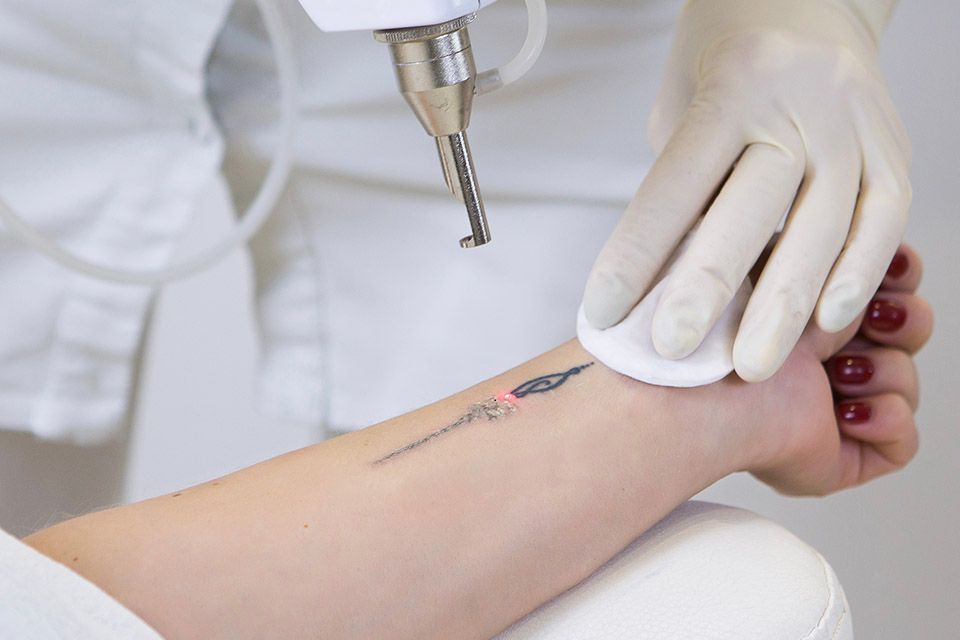 Laser Tattoo Removal: A Modern Approach to Erasing Ink